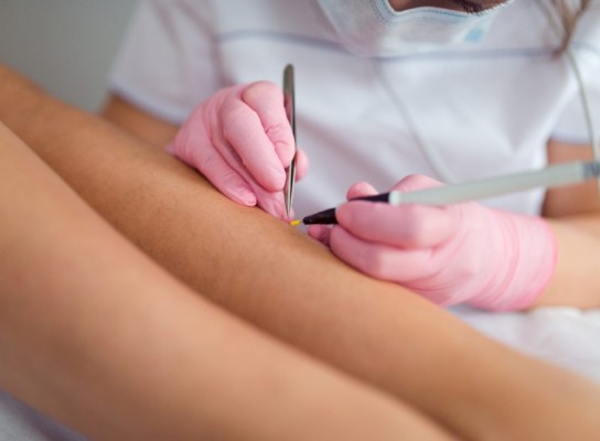 Elektroepilacija iglom